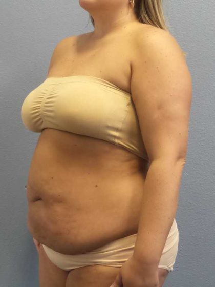 High BMI (Larger Patients) Surgery Before & After Patient #10274