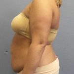 High BMI (Larger Patients) Surgery Before & After Patient #10274