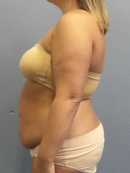 High BMI (Larger Patients) Surgery Before & After Patient #10274