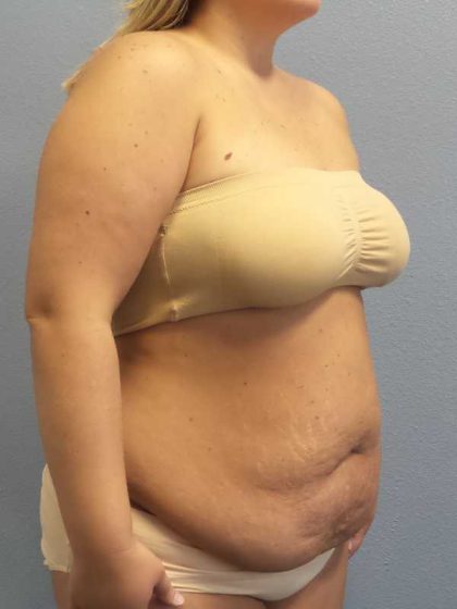 High BMI (Larger Patients) Surgery Before & After Patient #10274