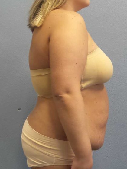 High BMI (Larger Patients) Surgery Before & After Patient #10274