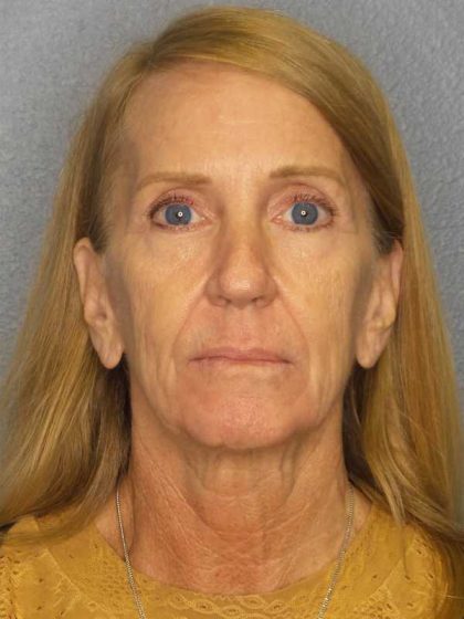 Facelift Before & After Patient #7576