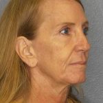 Rhinoplasty Before & After Patient #11062