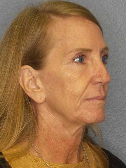 Facelift Before & After Patient #7576