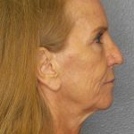 Rhinoplasty Before & After Patient #11062