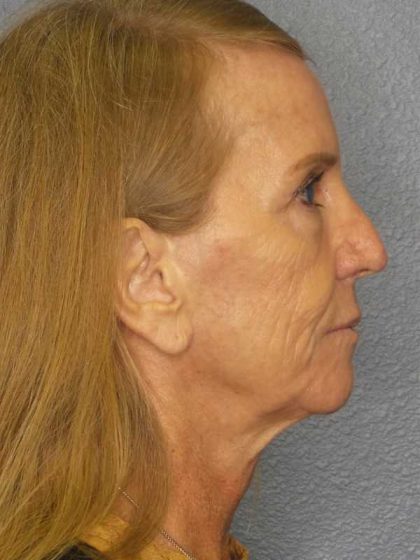 Facelift Before & After Patient #7576