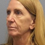 Facelift Before & After Patient #7576
