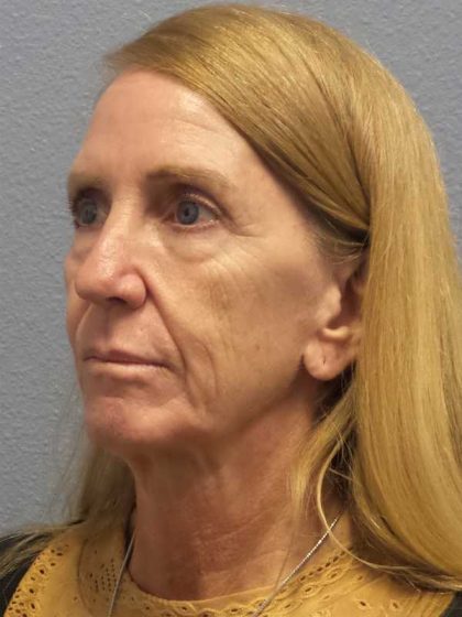 Facelift Before & After Patient #7576