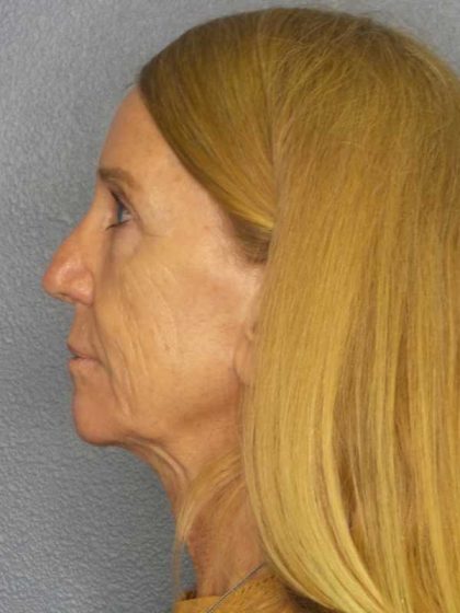 Rhinoplasty Before & After Patient #11062