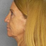 Facelift Before & After Patient #7576