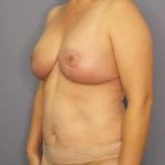 High BMI (Larger Patients) Surgery Before & After Patient #10455