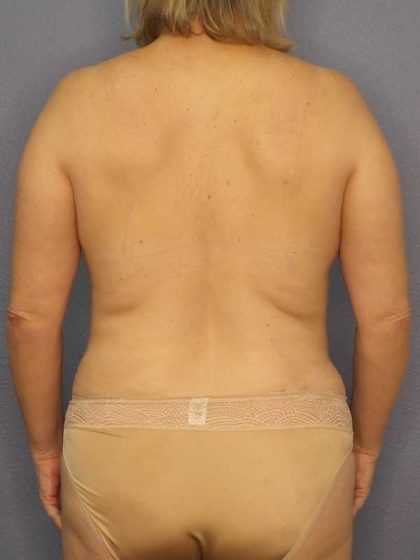 High BMI (Larger Patients) Surgery Before & After Patient #10455