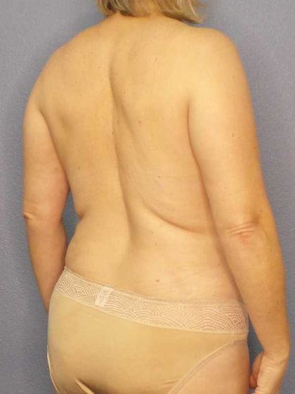 High BMI (Larger Patients) Surgery Before & After Patient #10455