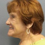 Facelift Before & After Patient #11887
