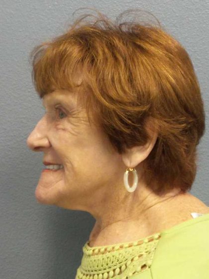 Facelift Before & After Patient #11887