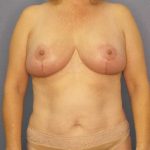 High BMI (Larger Patients) Surgery Before & After Patient #10455
