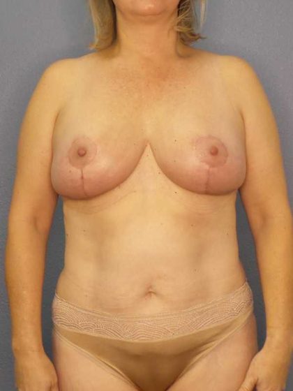 High BMI (Larger Patients) Surgery Before & After Patient #10455
