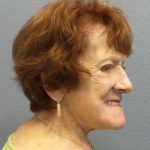 Facelift Before & After Patient #11887
