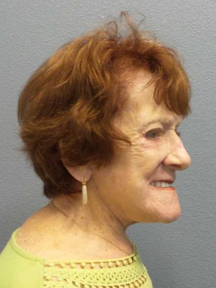 Facelift Before & After Patient #11887