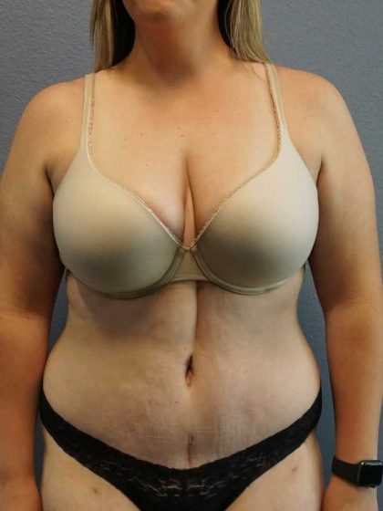 High BMI (Larger Patients) Surgery Before & After Patient #10273