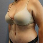 High BMI (Larger Patients) Surgery Before & After Patient #10273