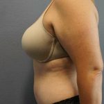 High BMI (Larger Patients) Surgery Before & After Patient #10273