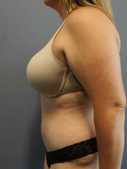 High BMI (Larger Patients) Surgery Before & After Patient #10273