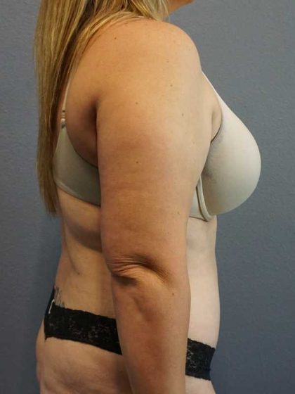 High BMI (Larger Patients) Surgery Before & After Patient #10273