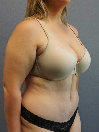 High BMI (Larger Patients) Surgery Before & After Patient #10273
