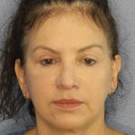 Facelift Before & After Patient #11661