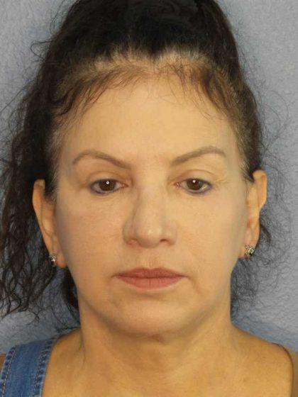 Facelift Before & After Patient #11661