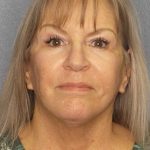 Facelift Before & After Patient #11842
