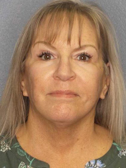 Facelift Before & After Patient #11842