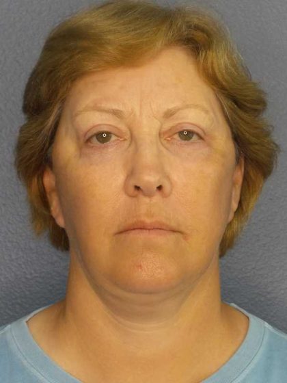 Facelift Before & After Patient #7556