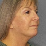 Facelift Before & After Patient #11842