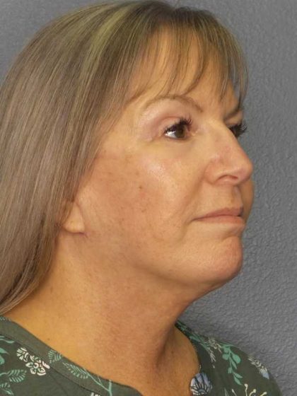 Facelift Before & After Patient #11842