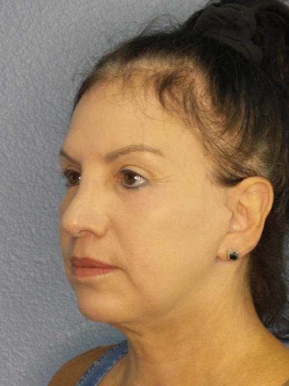 Facelift Before & After Patient #11661
