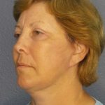 Facelift Before & After Patient #7556