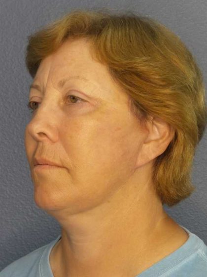 Facelift Before & After Patient #7556