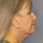 Facelift Before & After Patient #11842
