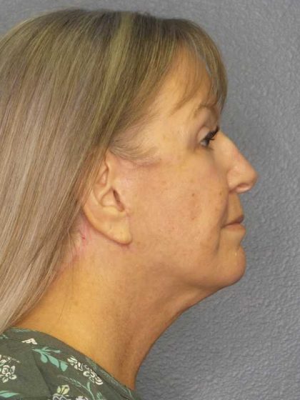 Facelift Before & After Patient #11842