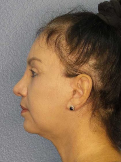 Facelift Before & After Patient #11661