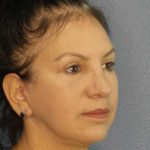 Facelift Before & After Patient #11661
