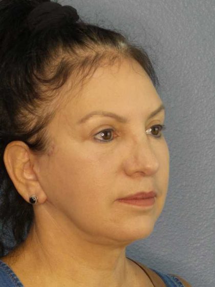 Facelift Before & After Patient #11661