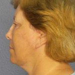 Facelift Before & After Patient #7556
