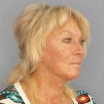 Facelift Before & After Patient #11767