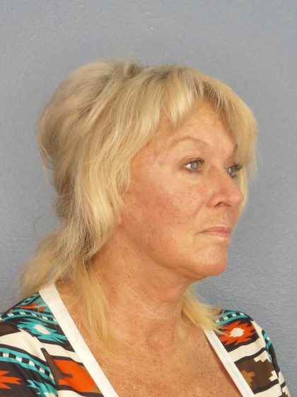 Facelift Before & After Patient #11767