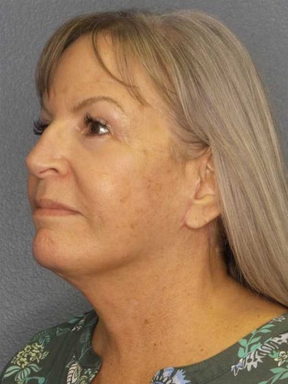 Facelift Before & After Patient #11842