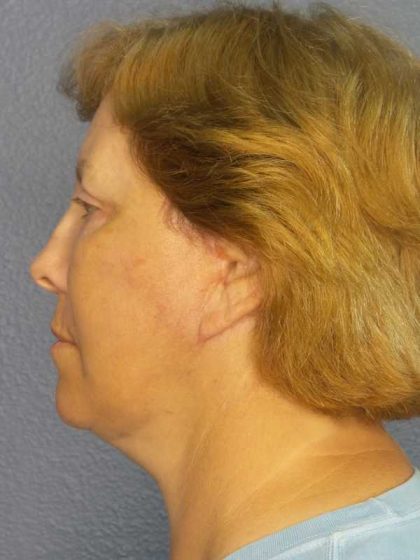 Facelift Before & After Patient #7556