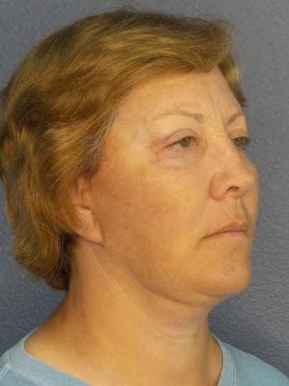 Facelift Before & After Patient #7556